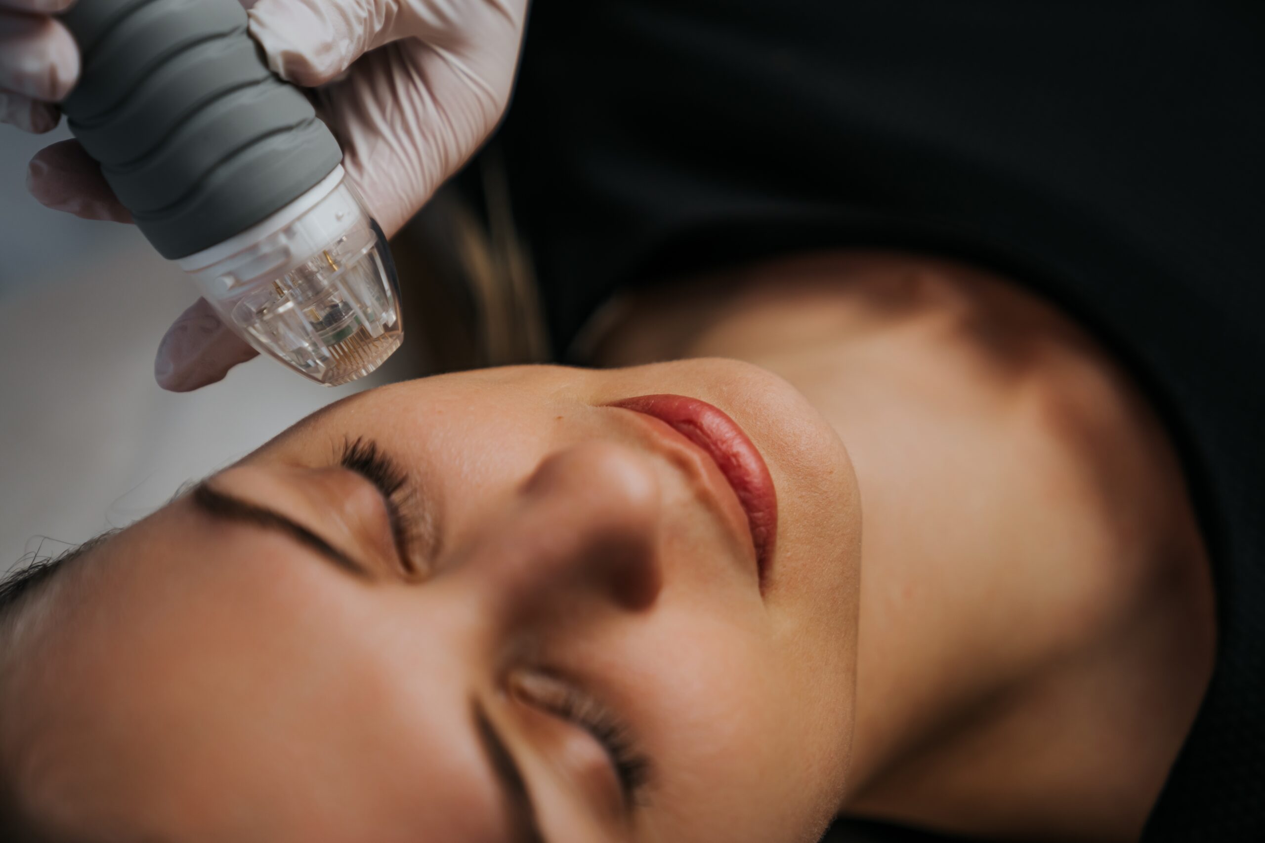 What Are the Benefits of Microneedling?
