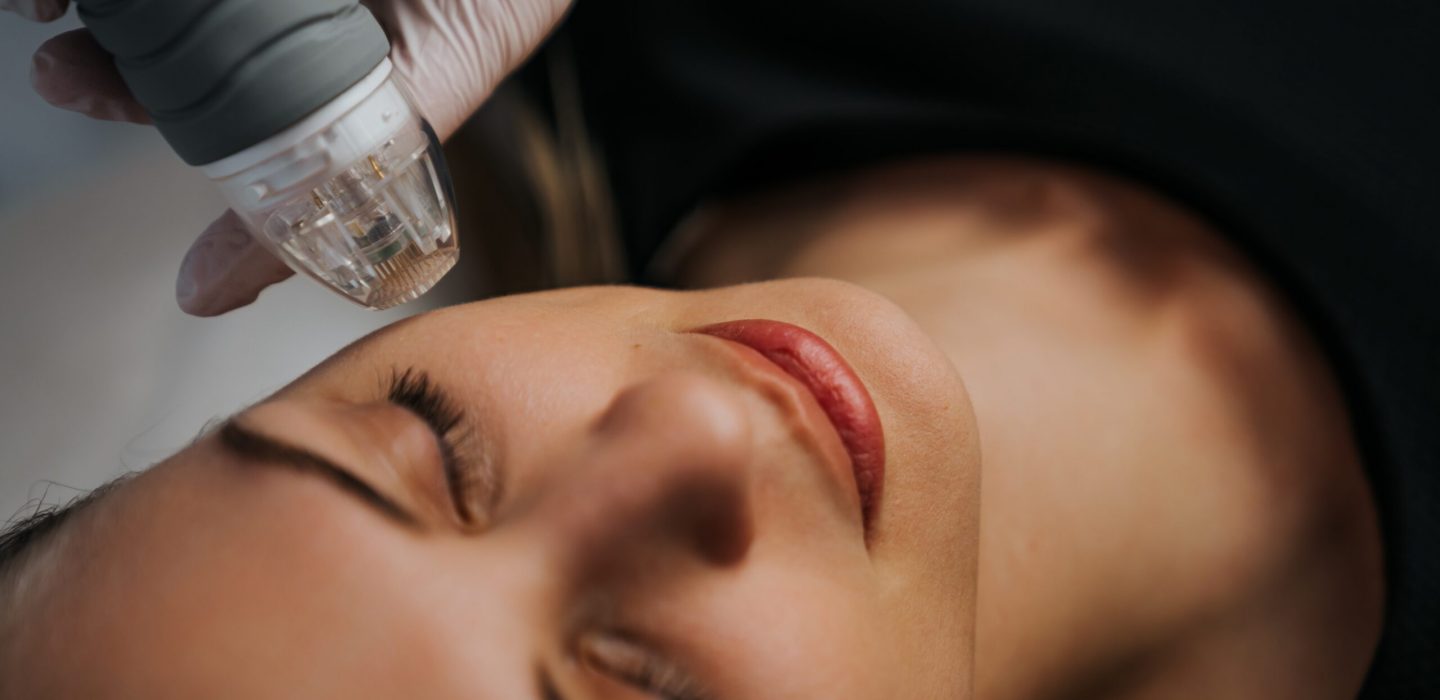 What Are the Benefits of Microneedling?